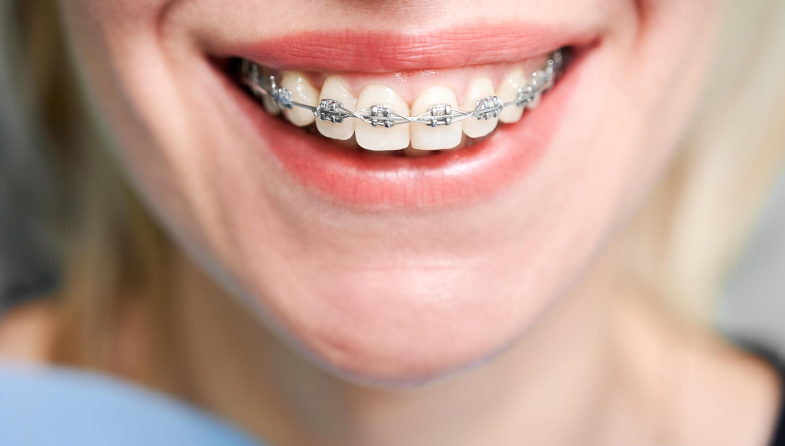 Patient smiling with braces