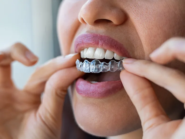 Invisalign clear aligners custom trays
